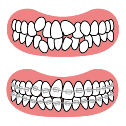 ガタガタ歯並びの矯正イメージ